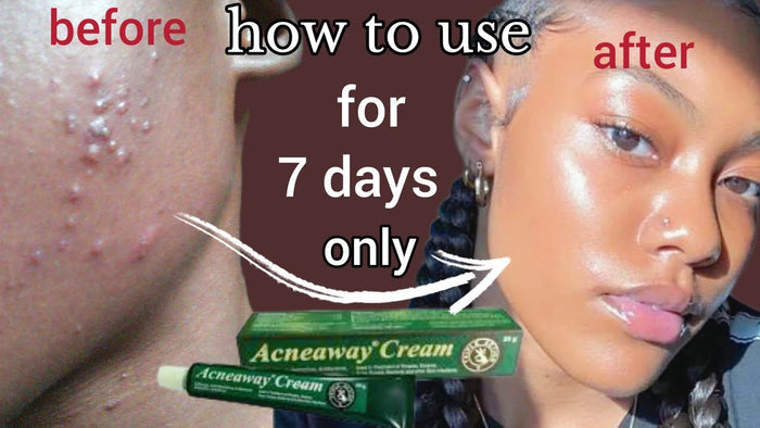 Acne Away medicated healer - Kismet Beauty Brands